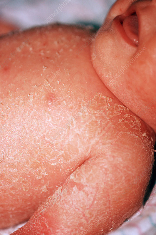 Staphylococcal Scalded Skin Syndrome