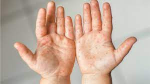 Flu Singapura (HFMD)