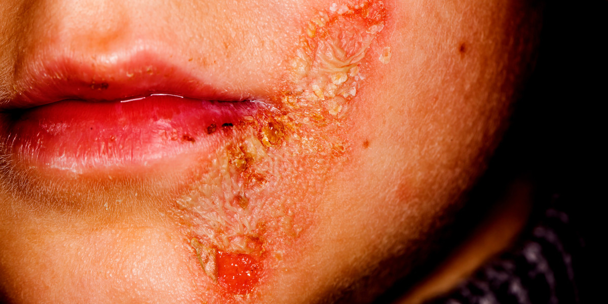 Penyakit Langka Sindrom Stevens Johnson, Begini Gejalanya