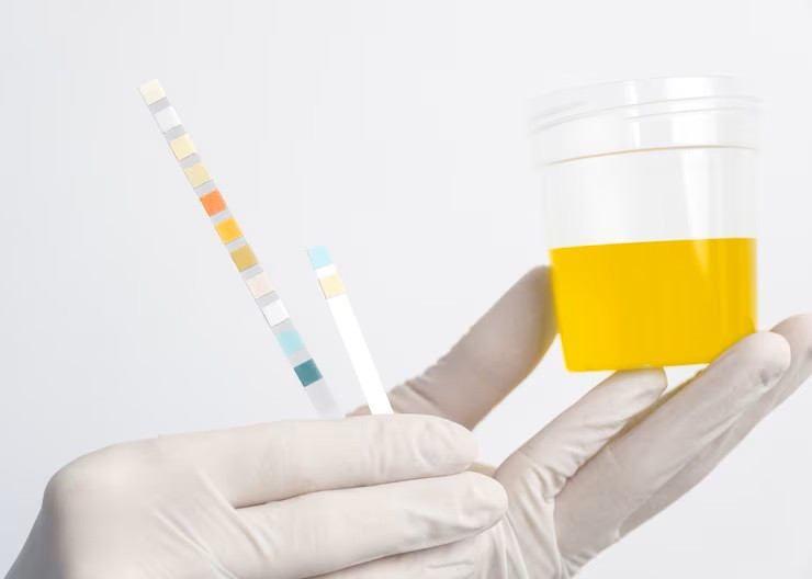 Jenis-Jenis Tes Urine Beserta Fungsinya