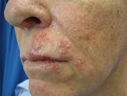 Gambar 1. Ruam herpes zoster. Credit: dermnetnz.org