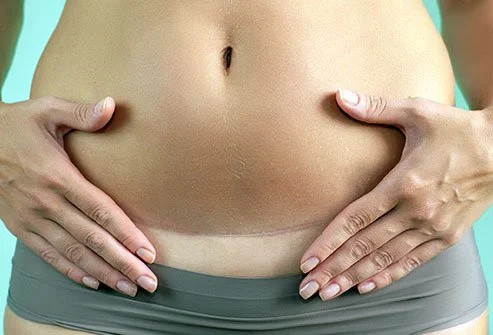 Rahim Terbalik: Benarkah Lebih Susah Hamil?